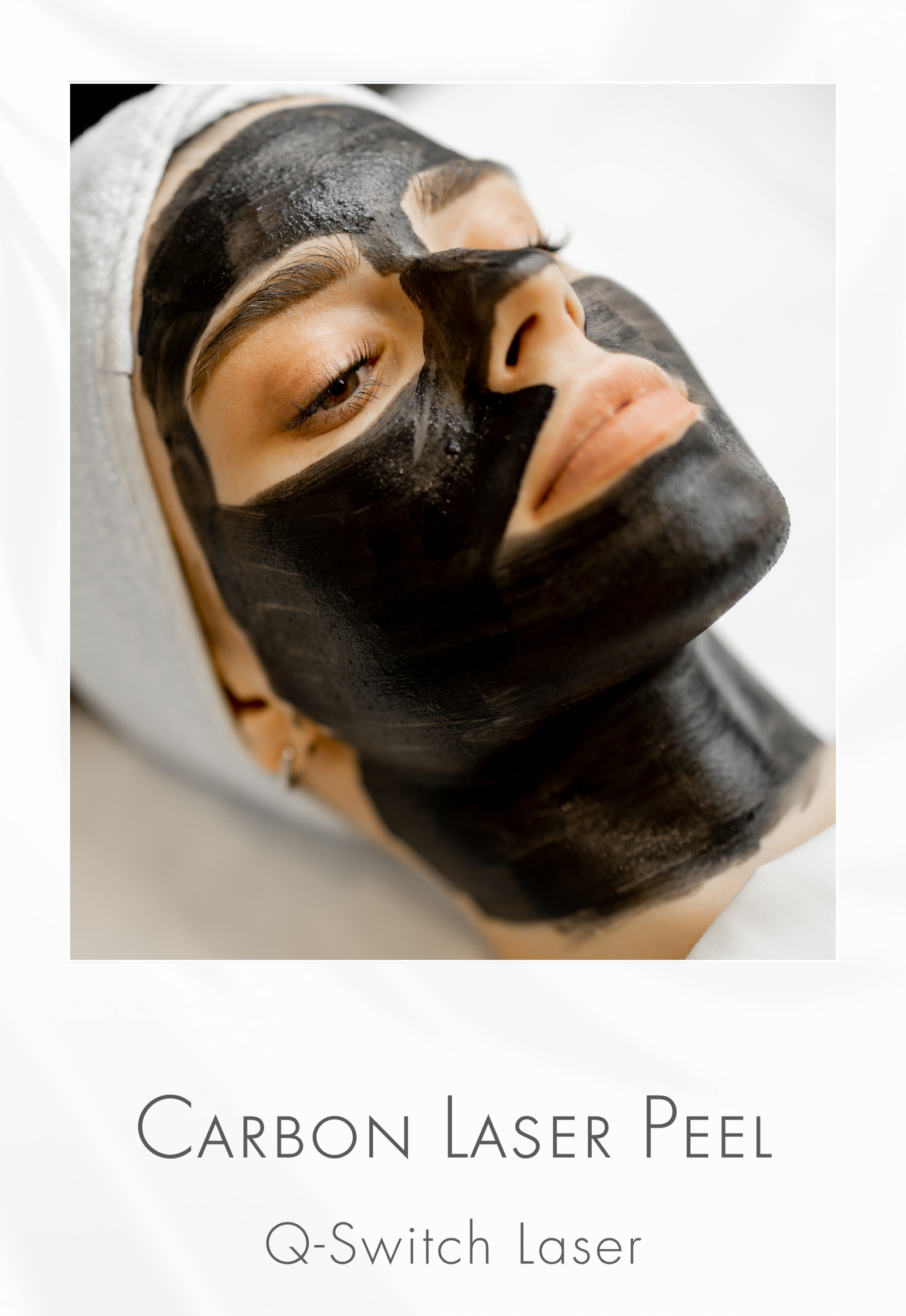 Carbon Laser Peel