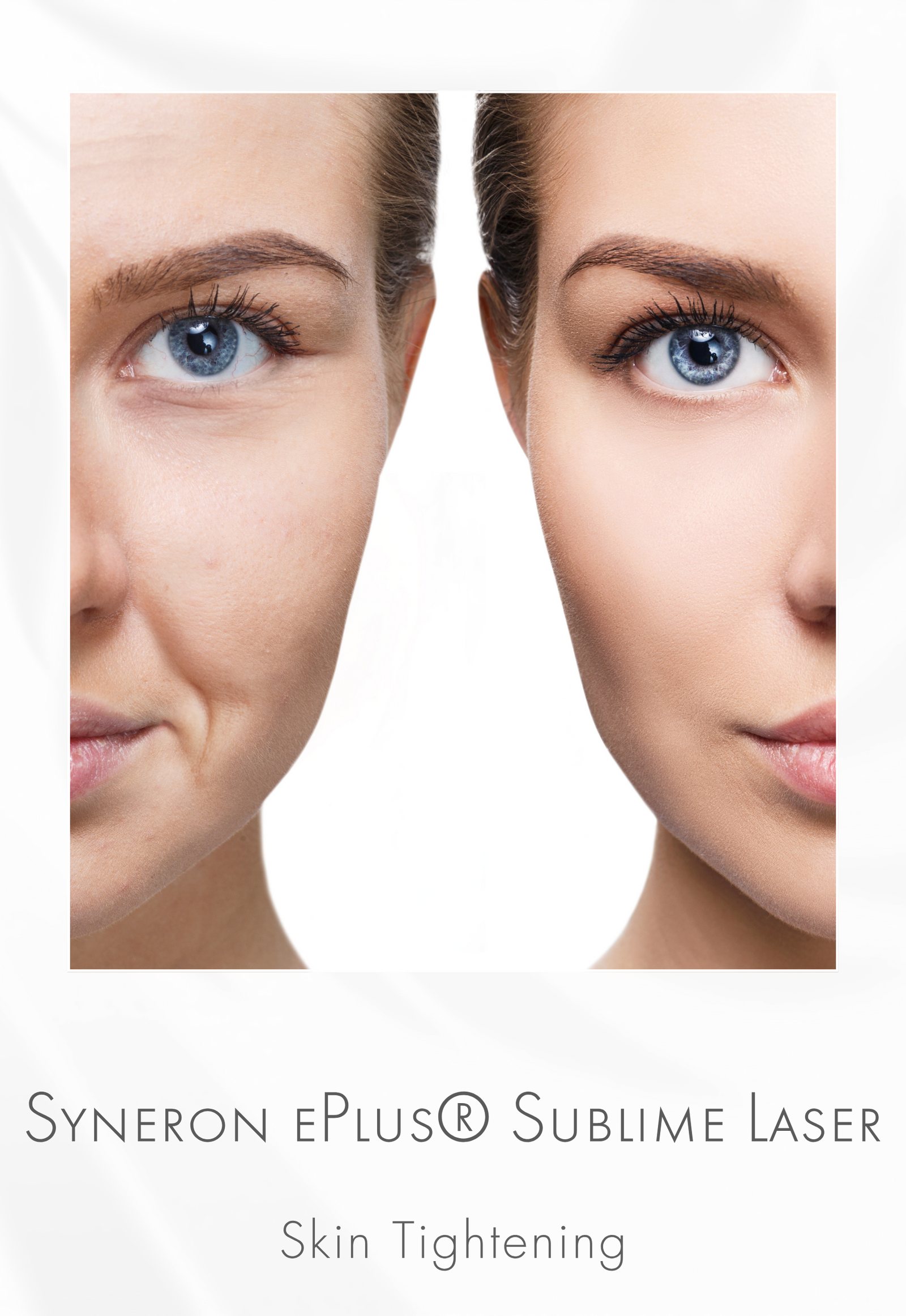Syneron ePlus® Sublime Skin Tightening Procedure