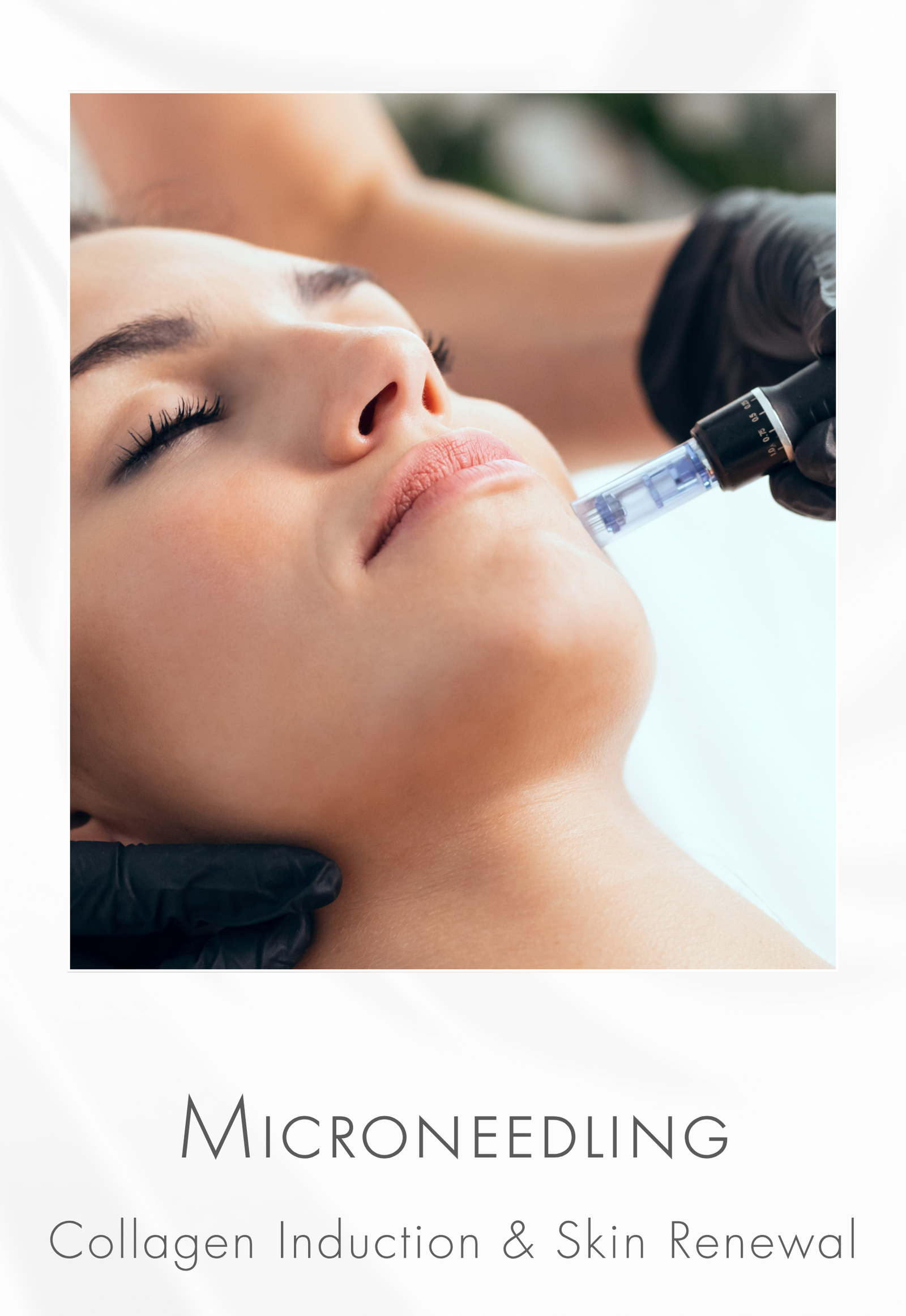 Microneedling