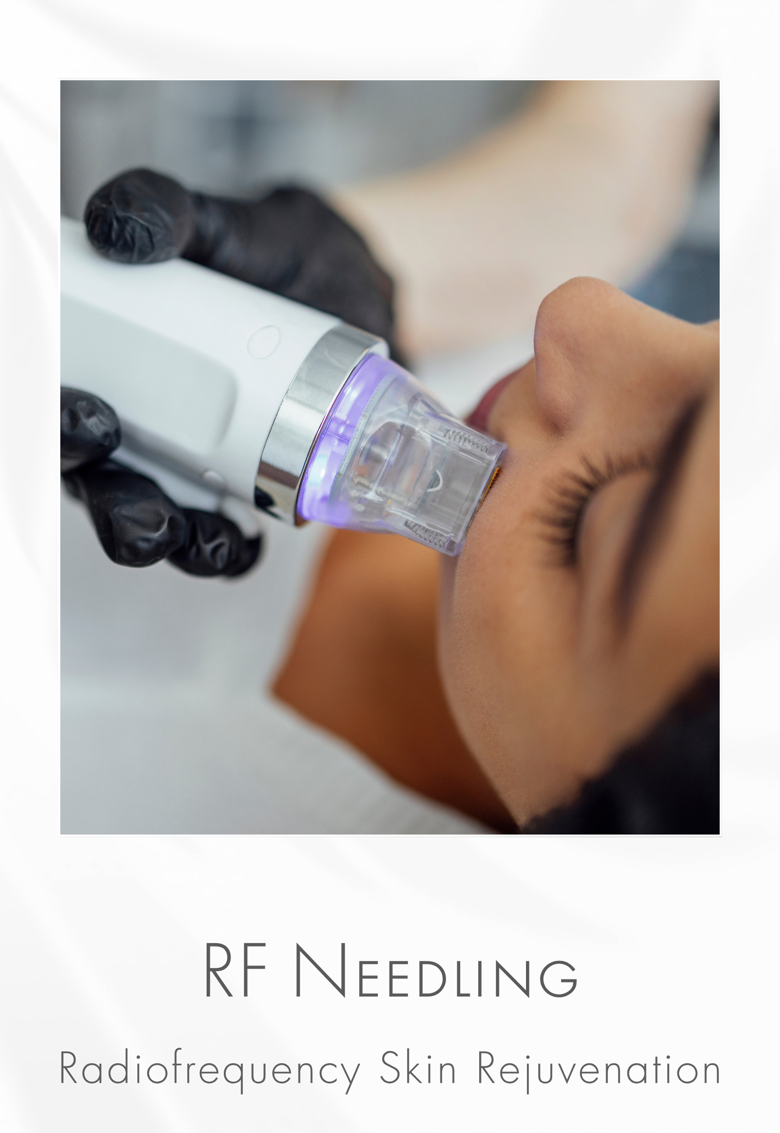 Fractionated RF Needling