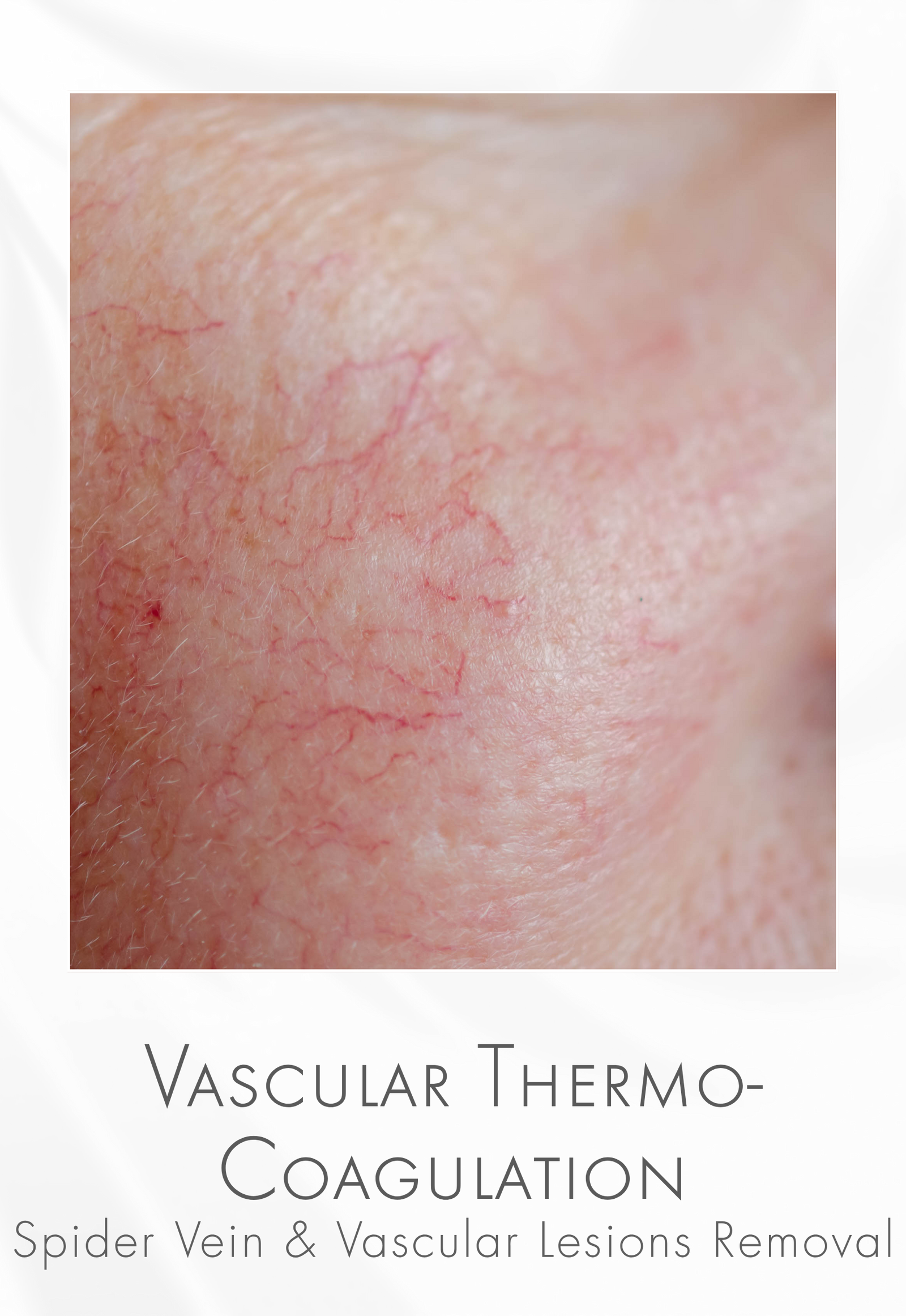 Vascular Thermo Coagulation - Spider™