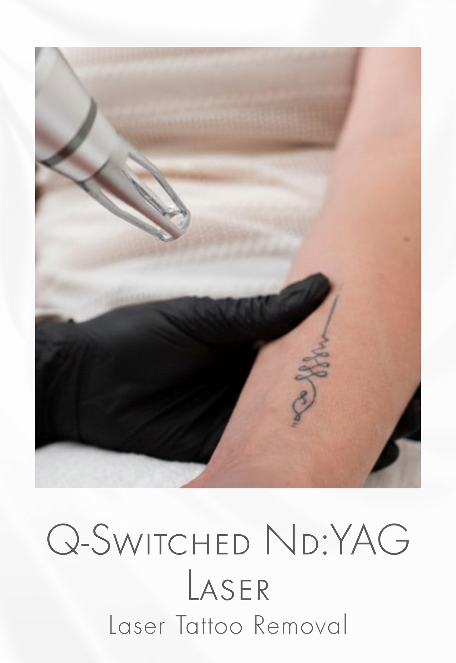Q-Switched Laser for Tattoo Removal