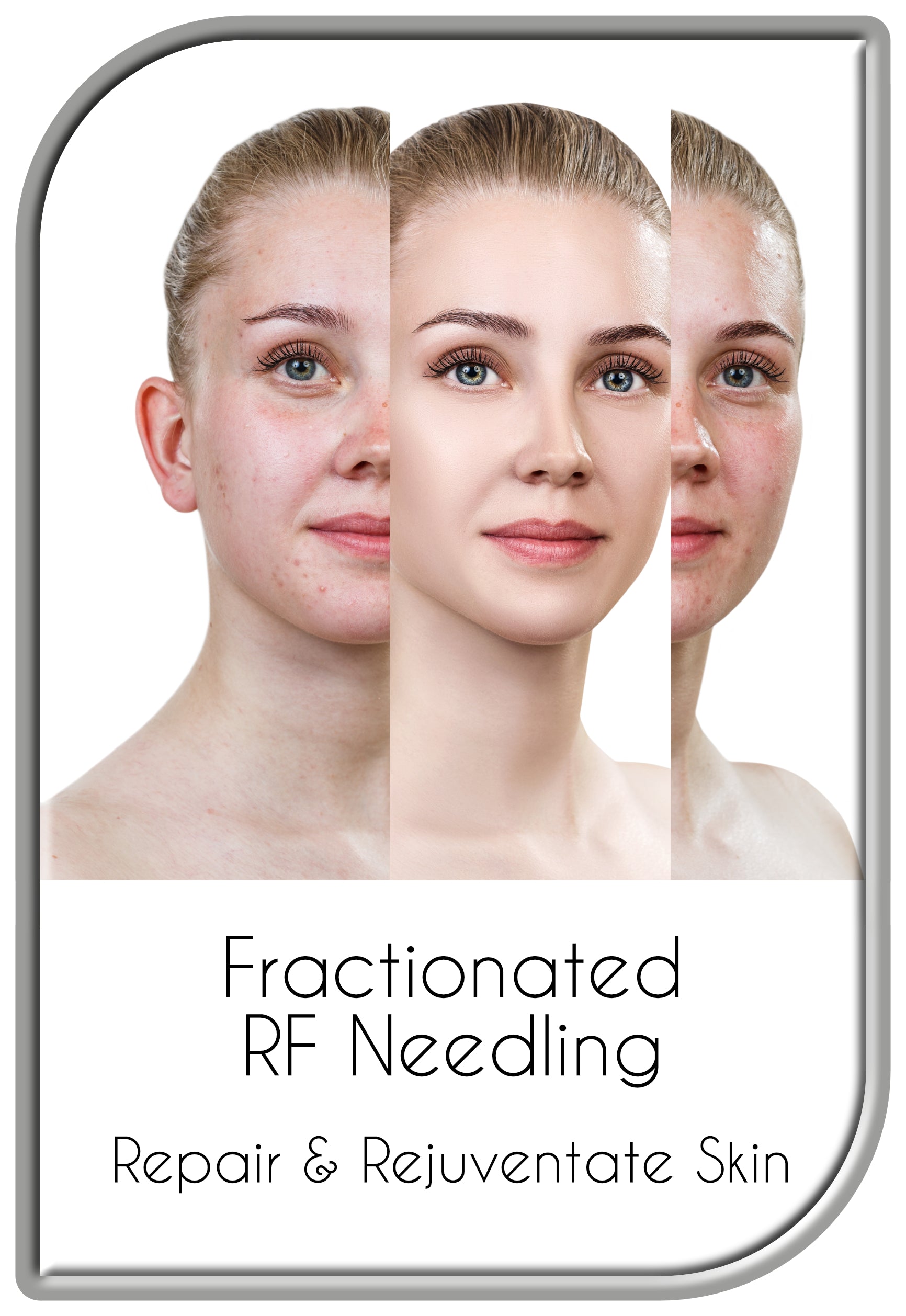 Fractionated RF Needling